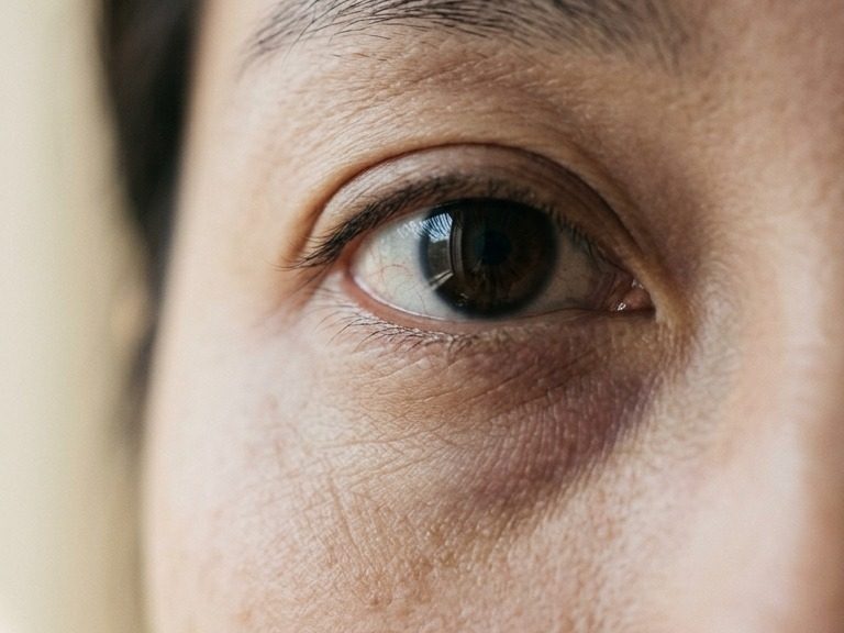 Close-up of the under-eye area showing subtle shadowing and skin texture, used to illustrate that dark circles have more than one cause