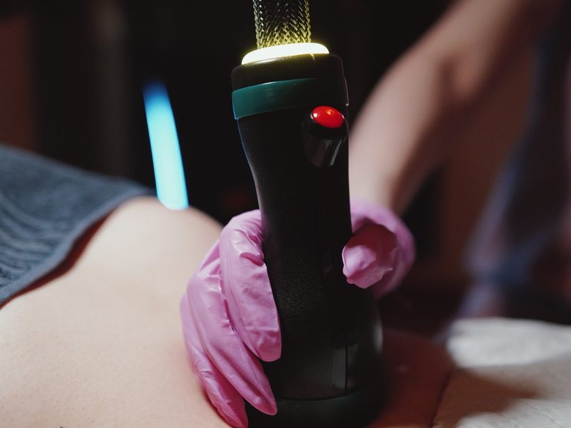 A clinical detail of the OndaPro treatment in progress.