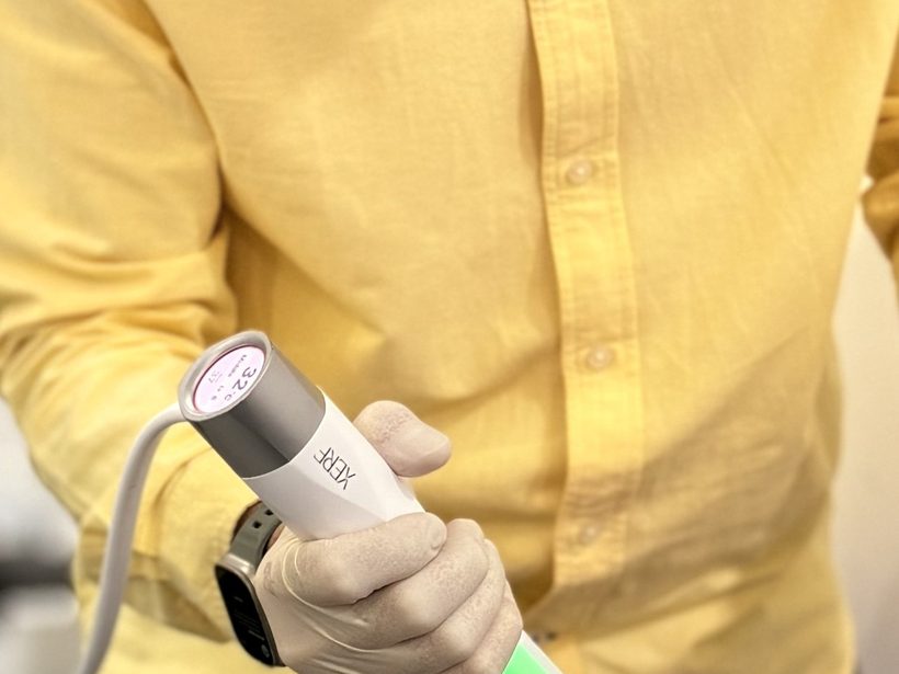 A gloved hand holding the XERF radiofrequency handpiece, its cooled tip reading 32 degrees Celsius